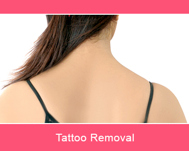 Tattoo Removal - TLC Dermal Laser Clinic, Surrey, BC, Canada